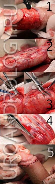1- осуществление доступа; 2- смещение кожи к основанию полового члена; 3- выделение и пересечение нервного волокна; 4- вид нервного волокна после ушития; 5- окончательный вид после операци