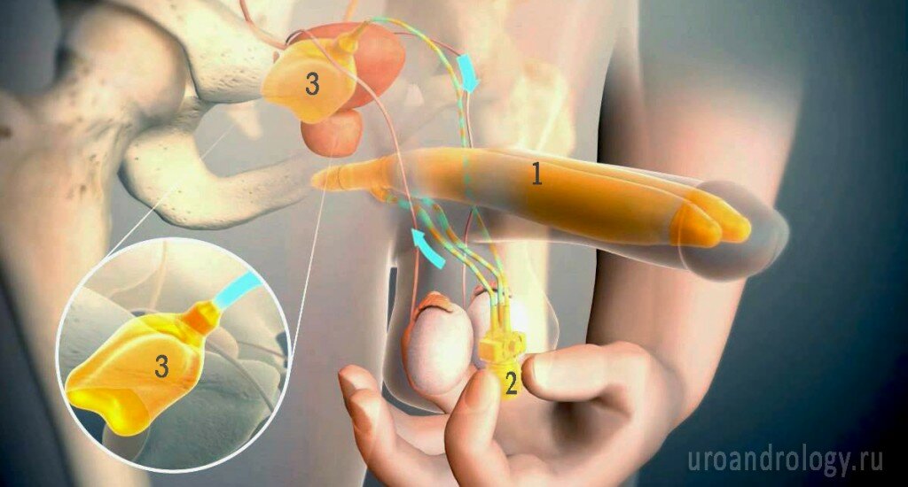 Рис -1 Трехкомпонентный гидравлический имплант, схема. Имплант состоит из 2 цилиндров (1) которые устанавливаются в пещеристые тела полового члена, резервуара с жидкостью в малом тазу (3) и помпы которую размещают в мошонке (2). При половом акте благодаря нескольким нажатиям на помпу, физиологический раствор выполняя функцию крови перетекает из резервуара в цилиндры, приводя к возникновению эрекции. После завершения полового акта, достаточно одного легкого нажатия на помпу и половой член вернется в исходное, спокойное состояние.