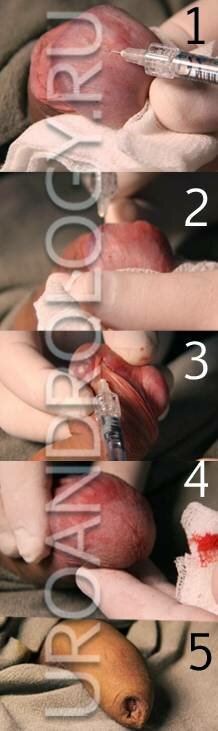1,2 -ведения геля в отделы головки; 3- введение геля в область уздечки полового члена; 4,5- окончательный вид после операции